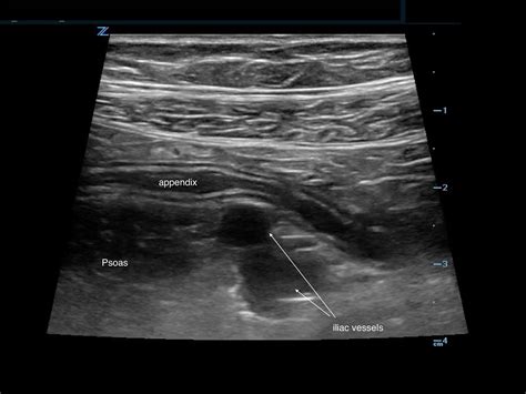 EM Ultrasound Section // How to Diagnose Appendicitis in a Child