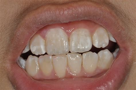 Why Do I Have White Streaks On My Teeth at Tim Dodd blog