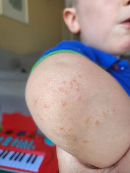 Image result for Exploding Elbow Pimple