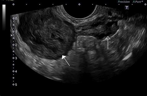 A Pedunculated Fibroid: The Master of Disguise - Journal of Obstetrics ...