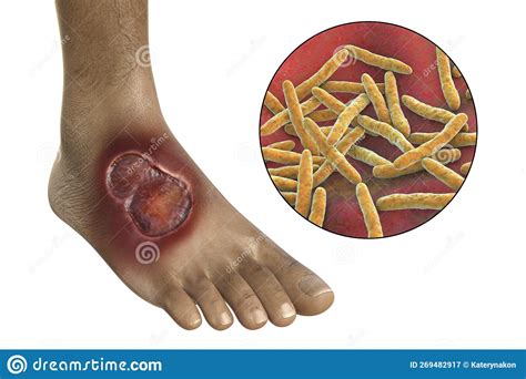 Buruli Ulcer on a Patient Foot, 3D Illustration. the Disease Caused by ...