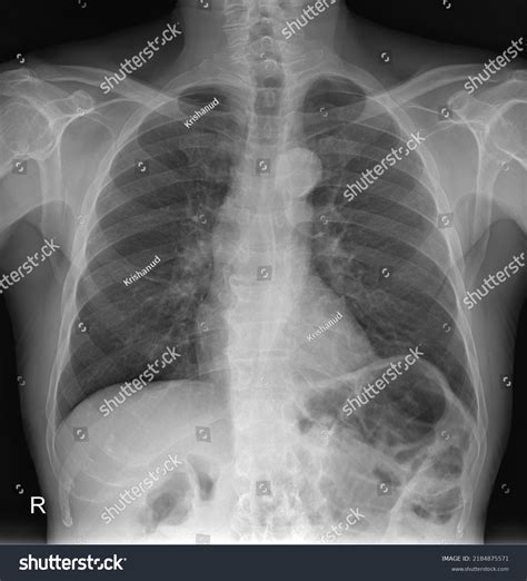 Erect Chext Xray Posteroanterior Radiograph Foto stock 2184875571 | Shutterstock