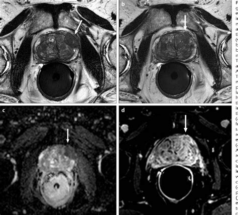 Mri Prostate Cancer Probability