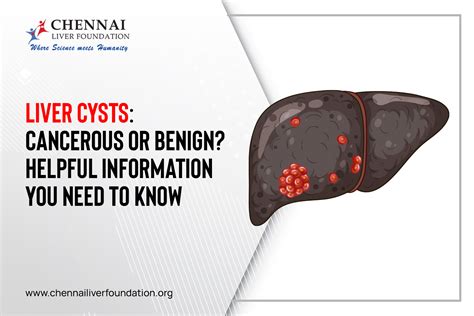 Ibuprofen And Liver Cysts at Erica Laforge blog