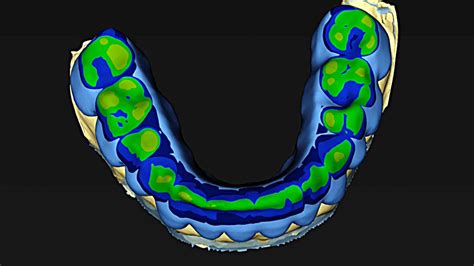 Image result for Inlab Splint Design