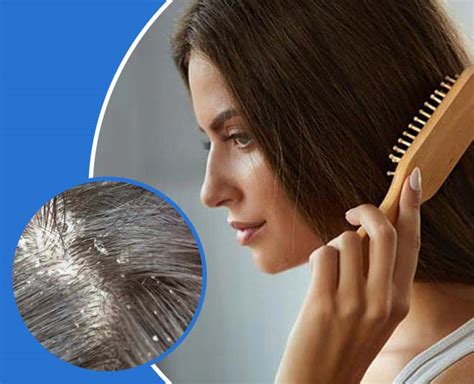 DIY Hair Care Tips: Dry Scalp And Dandruff Home Remedies | diy hair ...