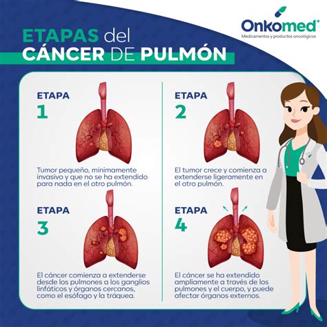 Etapas del cáncer de pulmón - Onkomed Farmacia