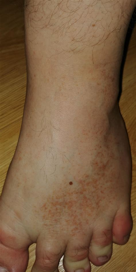 whats the brown spots on my foot its been growing over both my feet ? : r/medical_advice