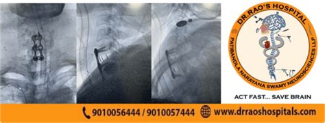 Anterior Cervical Discectomy and Fusion (ACDF) at Dr Raos