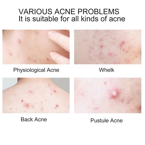 Buy Patch, Pimple Patch Skin Treatment Zit Patch Hydrocolloid Conceal ...