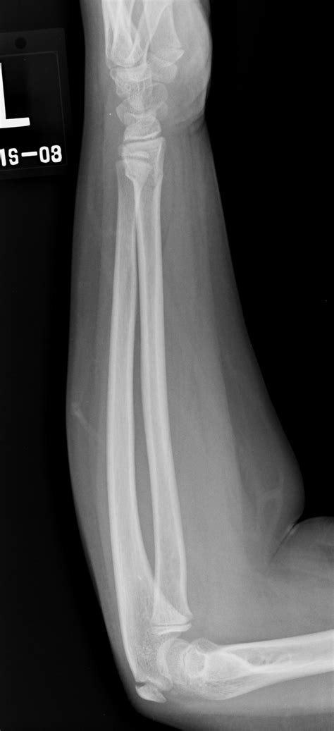 What Is A Buckle Fracture Of Radius at Ida Barrera blog