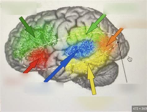 Image result for Conduction Aphasia