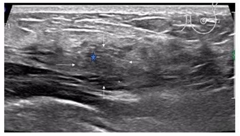 Progress in Ultrasound Research on Non-Mass Breast Lesions: Definition ...