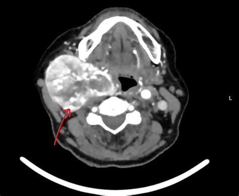 Carotid body tumor: characteristics and surgical outcome - PMC