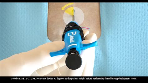 Image result for Perclose Device Tutorial