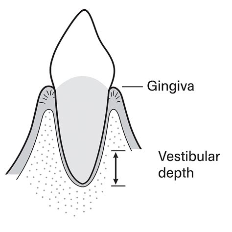 Depth Of Vestibule