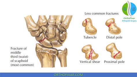 Scaphoid Fracture Test 的图像结果
