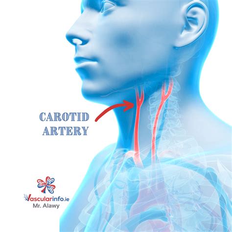 Carotid Body Tumor - Vascular Info