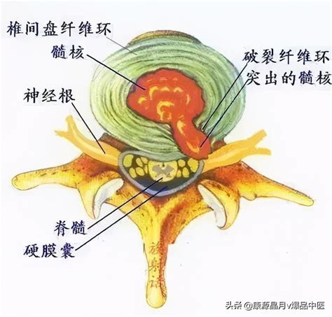 神经根型颈椎病有哪些症状_有来医生