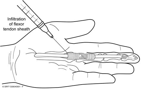 Trigger Finger Injection