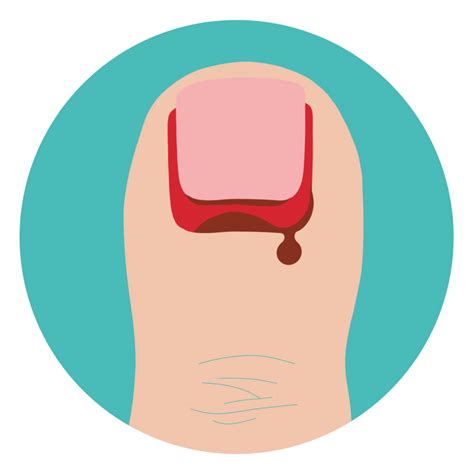 Toenail Trauma: Causes,Symptoms & Treatment