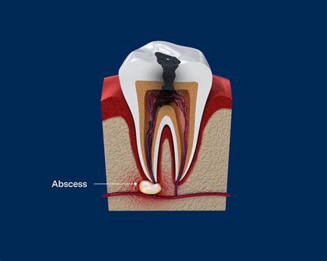 Dental Abscess: Symptoms, Types and Treatments | Aspen Dental