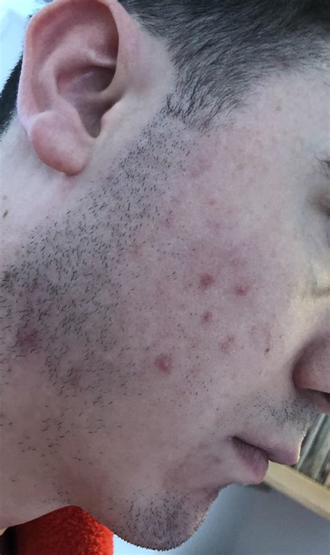 [acne] Whatever I use I cannot seem to rid my face of these red marks ...