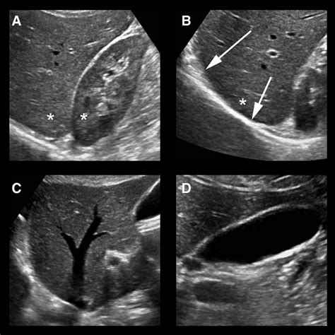 Normal Vs Fatty Liver Ultrasound