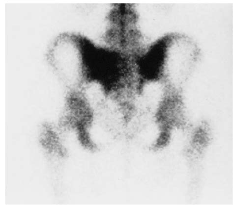 Image result for Radionuclide Scan