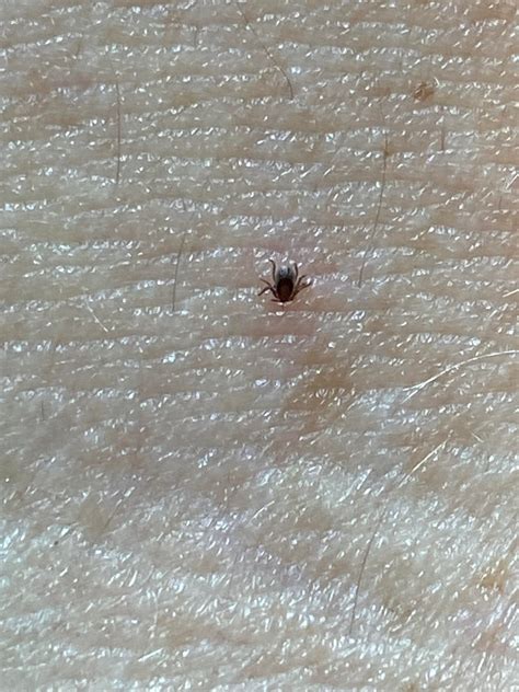 Image result for Embedded Deer Tick