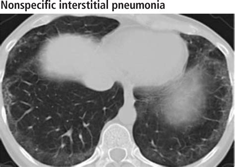 What Does Lung Scarring Look Like On Ct Scan Ct Scan Machine Imaging