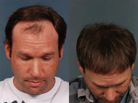 Best Hair Plugs