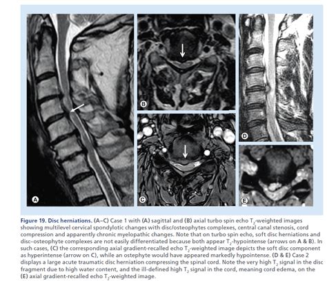 Imaging of spinal cord compression