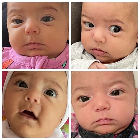 My baby still has puffy swollen eyes - anyone else? | BabyCenter