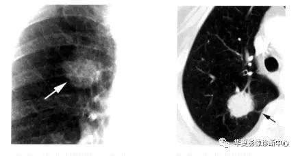 CT报告单提示有肺结节，但却弄不清良恶性？看看专家怎么做的_病变