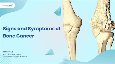Cáncer de huesos: síntomas, causas, diagnóstico y tratamiento ...