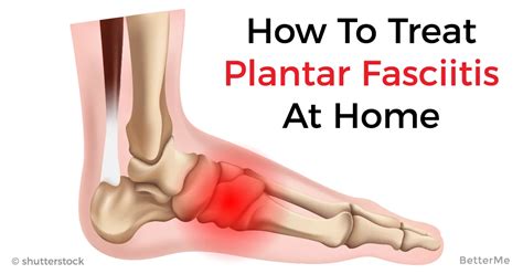 Amazing treatment of plantar fasciitis at home