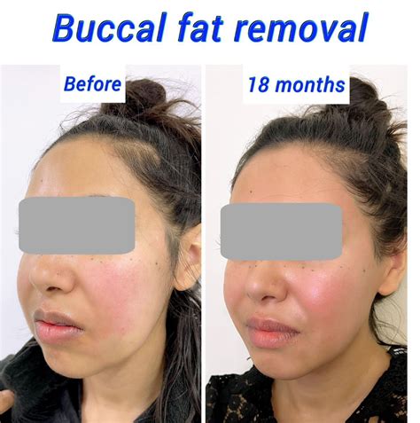 Buccal Fat Removal Local Anesthesia at Valerie Fisher blog