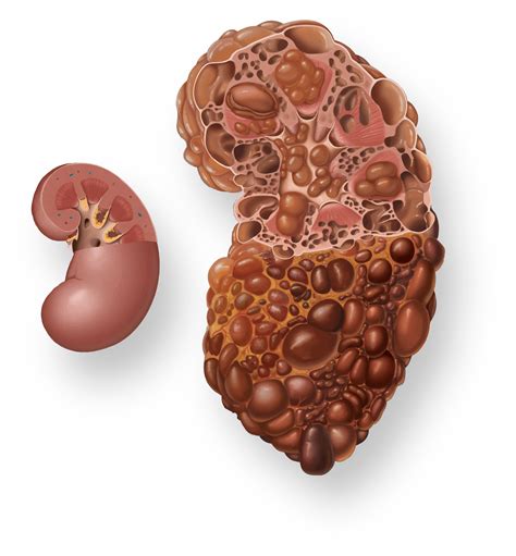 PKD Awareness Day Sept. 4 | Polycystic kidney disease | PKD Foundation