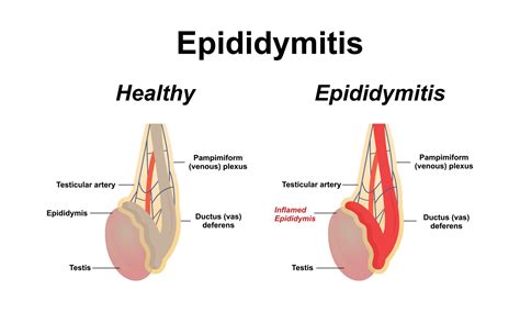Epididymitis