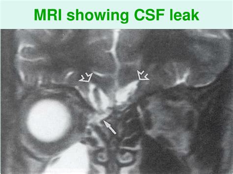 Leaking Csf Nose