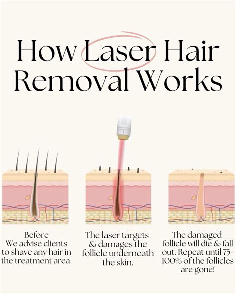 How laser hair removal works / diagram & post inspo for esthetician ...