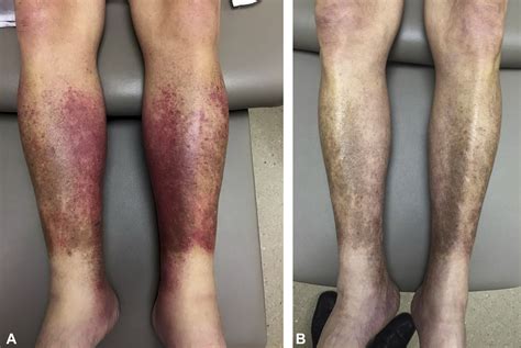 Gemcitabine-associated acute lipodermatosclerosislike eruption: An underrecognized phenomenon ...
