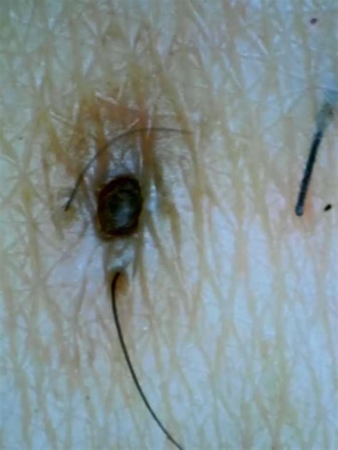 Ingrown hair on penile shaft removal identification and causes – Artofit