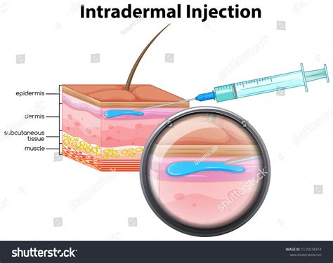 Intradermal Injection On White Background Illustration Stock Vector (Royalty Free) 1125078314 ...