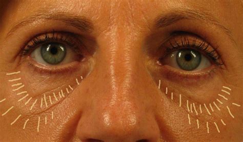 Do Under Eye Fat Injections Really Work? | Dr. Brett Kotlus, Cosmetic Oculoplastic Surgeon, NYC