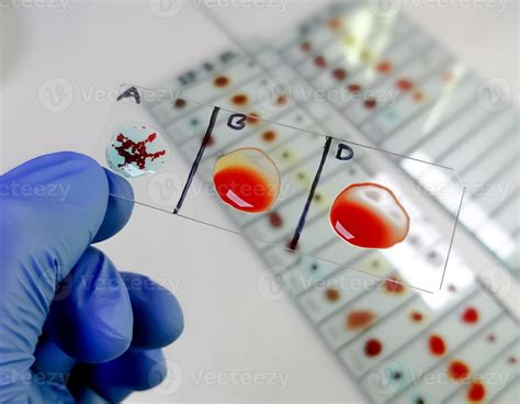 A Negative blood type, one of the rare blood group in worldwide. Blood group and Rh factor ...
