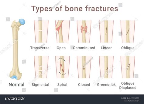 Oblique Fracture Healing Factors Influencing Fracture Healing Sara