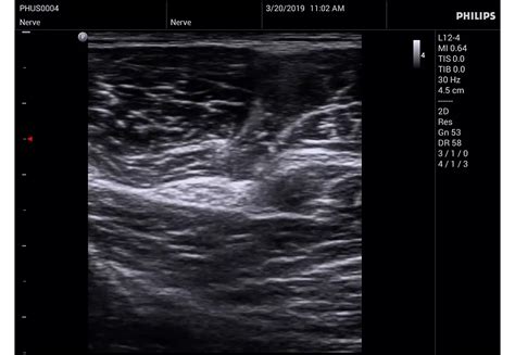 Philips - InnoSight compact ultrasound system