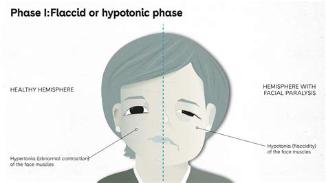 Evolution of Facial Paralysis | PortalCLÍNIC